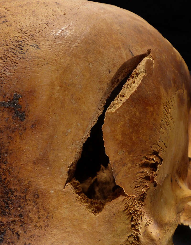Detalle de una marca producida por el golpe de un khepesh en el cráneo de uno de los soldados muertos en combate.