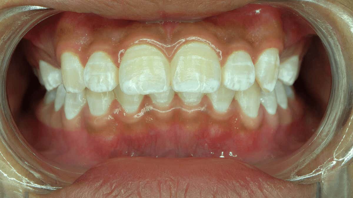 Manchas blancas en los dientes