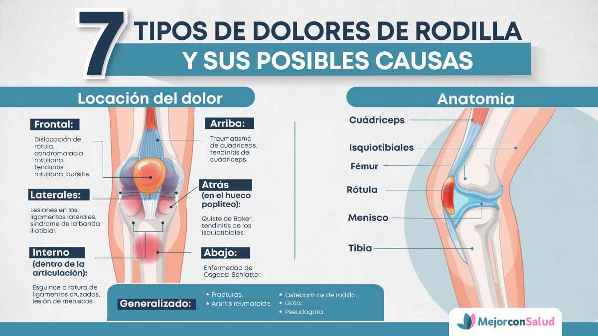 Locaciones de los distintos tipos de dolores de rodilla.