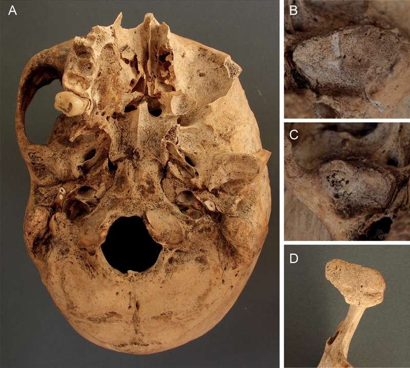 Artrosis de la articulación temporomandibular de uno de los individuos estudiados. A. Base del cráneo con ambas fosas mandibulares que muestran artrosis. B. Eburnación en la fosa mandibular izquierda. C. Lesiones subcondrales en la fosa mandibular derecha. D. Deformación del contorno articular y cambios marginales del proceso condilar izquierdo.
